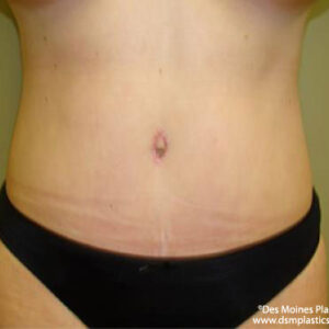 Tummy Tuck before and after photos