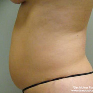 Tummy Tuck before and after photos