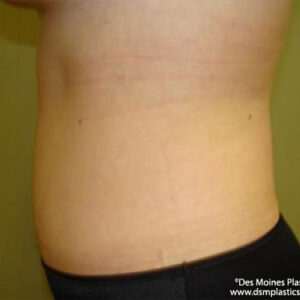 Tummy Tuck before and after photos