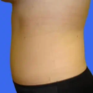 Tummy Tuck before and after photos Tummy Tuck before and after photos