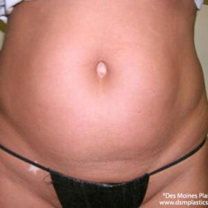 Liposuction before and after photos