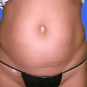 Liposuction before and after photos Liposuction before and after photos