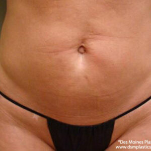 Liposuction before and after photos