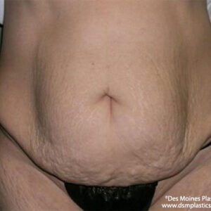 Tummy Tuck before and after photos