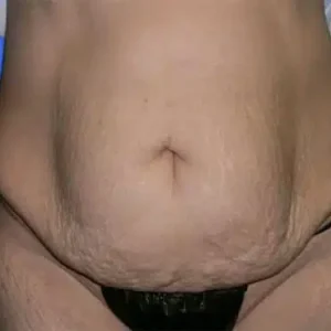 Tummy Tuck before and after photos Tummy Tuck before and after photos