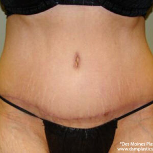 Tummy Tuck before and after photos