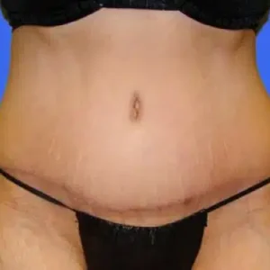 Tummy Tuck before and after photos Tummy Tuck before and after photos