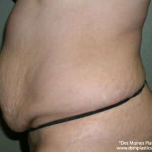 Tummy Tuck before and after photos