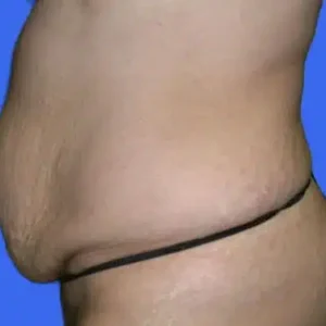 Tummy Tuck before and after photos Tummy Tuck before and after photos