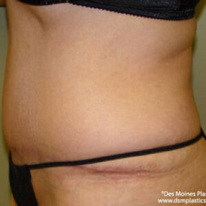 Tummy Tuck before and after photos