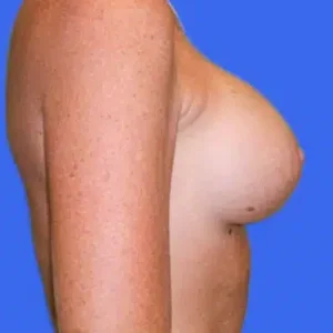 Breast Augmentation before and after photos Breast Augmentation before and after photos