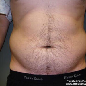 Liposuction before and after photos