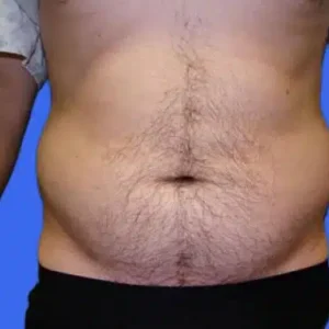 Liposuction before and after photos Liposuction before and after photos