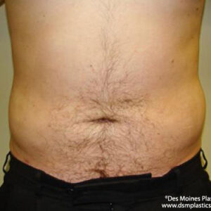 Liposuction before and after photos