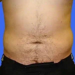 Liposuction before and after photos Liposuction before and after photos