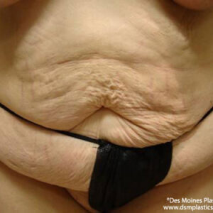 Tummy Tuck before and after photos