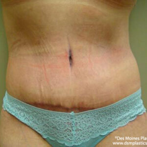 Tummy Tuck before and after photos