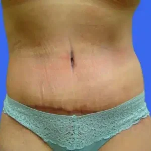 Tummy Tuck before and after photos Tummy Tuck before and after photos