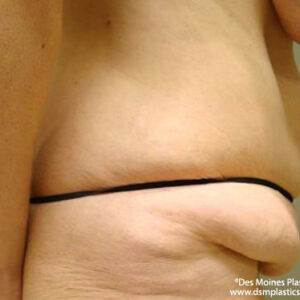 Tummy Tuck before and after photos