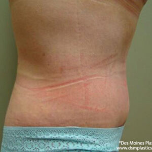 Tummy Tuck before and after photos
