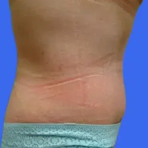 Tummy Tuck before and after photos Tummy Tuck before and after photos