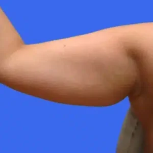 Liposuction before and after photos Liposuction before and after photos