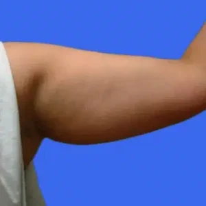 Liposuction before and after photos Liposuction before and after photos