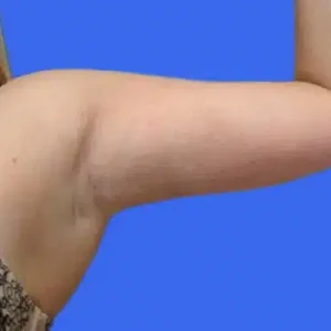 Liposuction before and after photos Liposuction before and after photos