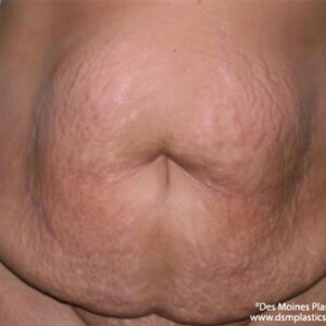Tummy Tuck before and after photos