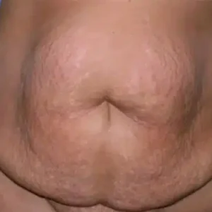 Tummy Tuck before and after photos Tummy Tuck before and after photos