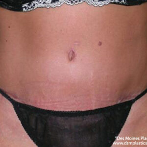 Tummy Tuck before and after photos