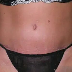 Tummy Tuck before and after photos Tummy Tuck before and after photos