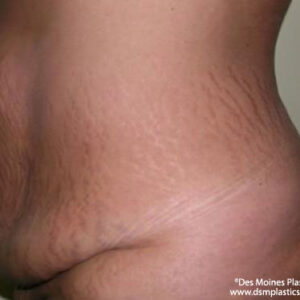 Tummy Tuck before and after photos