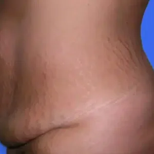 Tummy Tuck before and after photos Tummy Tuck before and after photos