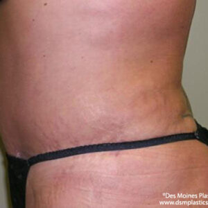 Tummy Tuck before and after photos