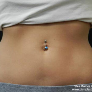 CoolSculpting before and after photos