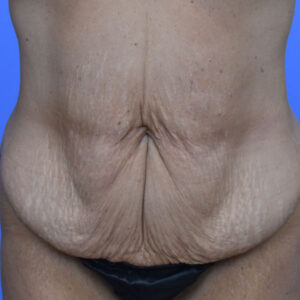 Tummy Tuck before and after photos