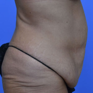 Tummy Tuck before and after photos