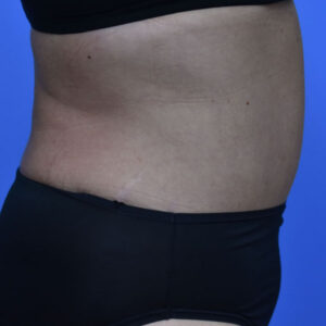 Tummy Tuck before and after photos