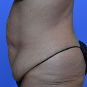 Tummy Tuck before and after photos