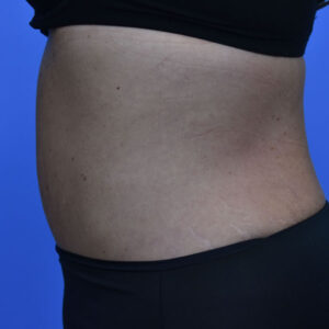 Tummy Tuck before and after photos