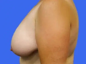 Breast Reduction before and after photos