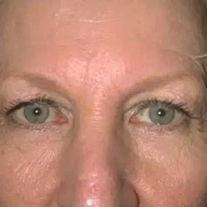 Brow Lift before and after photos