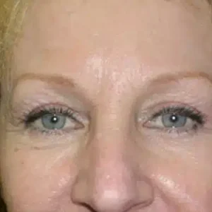 Brow Lift before and after photos