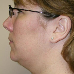 Neck Liposuction before and after photos