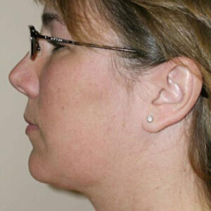 Neck Liposuction before and after photos