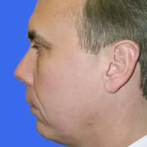 Chin Augmentation before and after photos