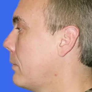 Chin Augmentation before and after photos