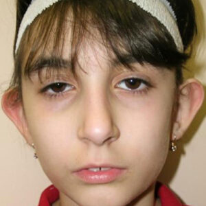 Ear Surgery before and after photos