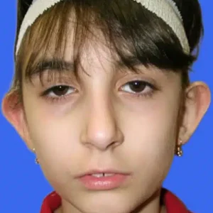 Ear Surgery before and after photos